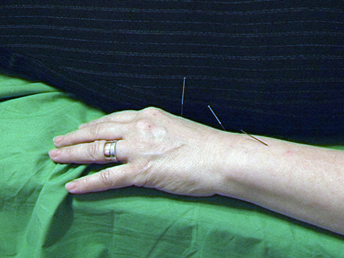 Acupunctura